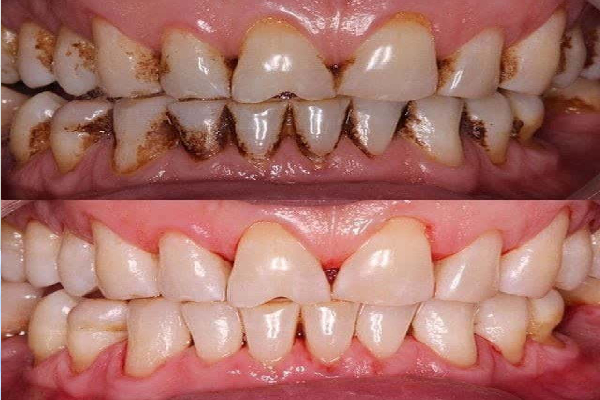 Teeth Cleaning